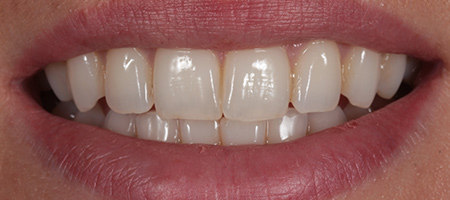 Bonding-b-3 Before & after cosmetic bonding