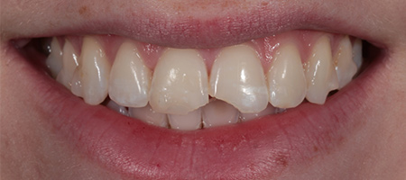 Bonding-b-4 Before & after cosmetic bonding