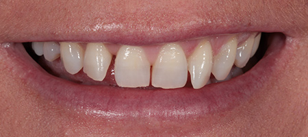 Bonding-b-5 Before & after cosmetic bonding
