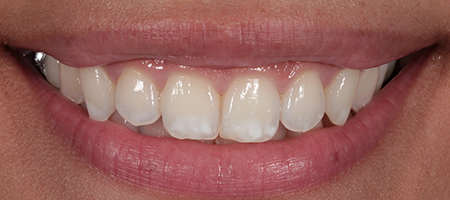 Bonding-b-6 Before & after cosmetic bonding