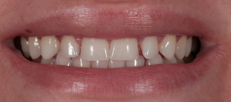 Bonding-b-7 Before & after cosmetic bonding