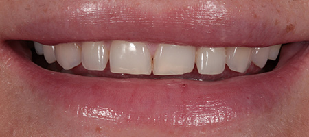 Bonding-b-8 Before & after cosmetic bonding