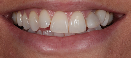 Bonding-b-9 Before & after cosmetic bonding