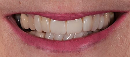 CROWDING - Composte bonding-a After Invisalign Treatment Reading Smiles