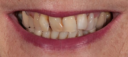 CROWDING - Composte bonding-b Before & after cosmetic bonding