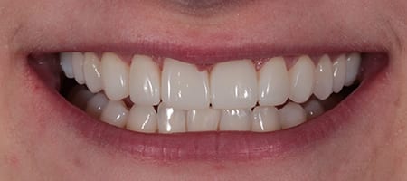Composite Bonding 1-a After Invisalign Treatment Reading Smiles
