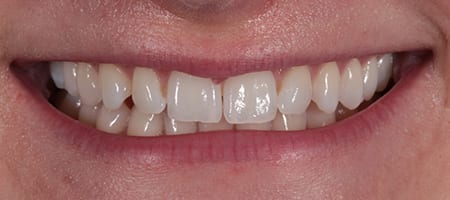 Composite Bonding 1-b Before & after cosmetic bonding
