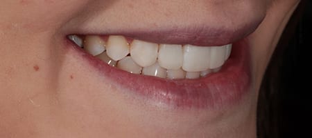 Composite Bonding 4 teeth-a-1 After Invisalign Treatment Reading Smiles