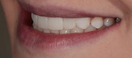 Composite Bonding 4 teeth-a-2 After Invisalign Treatment Reading Smiles