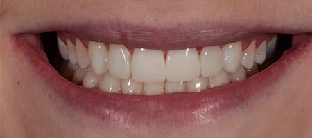 Composite Bonding 4 teeth-a After Invisalign Treatment Reading Smiles