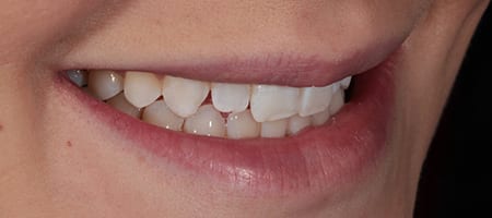Composite Bonding 4 teeth-b-1 Before & after cosmetic bonding