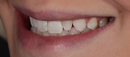 Composite Bonding 4 teeth-b-2 Before & after cosmetic bonding