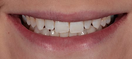 Composite Bonding 4 teeth-b Before & after cosmetic bonding