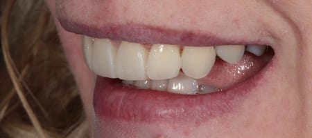 Crowded teeth - treatment composite bonding-a After Invisalign Treatment Reading Smiles