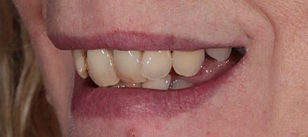 Crowded teeth - treatment composite bonding-b Before & after cosmetic bonding