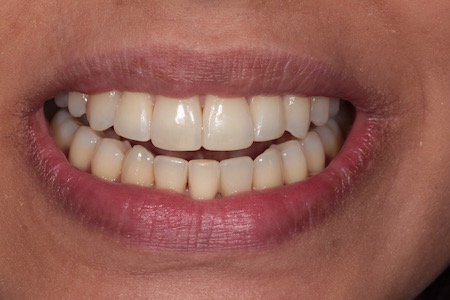 After Veneers Treatment Reading Smiles After Veneers Treatment Reading Smiles