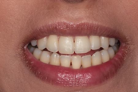 Before veneers Treatment Reading Smiles Before veneers Treatment Reading Smiles