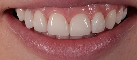 Gappy smile - Composite Bonding-a After Invisalign Treatment Reading Smiles