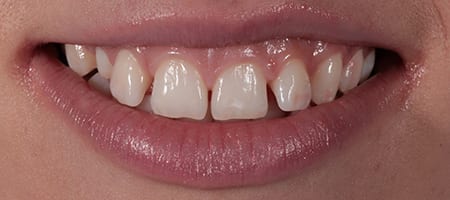 Gappy smile - Composite Bonding-b Before & after cosmetic bonding