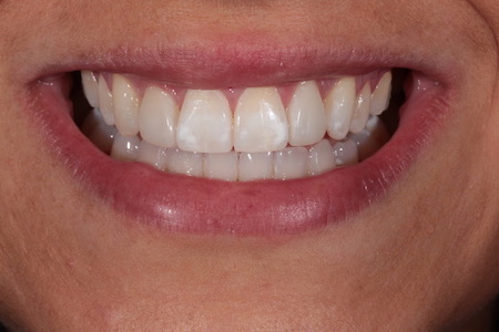 After Invisalign Treatment Reading Smiles After Invisalign Treatment Reading Smiles