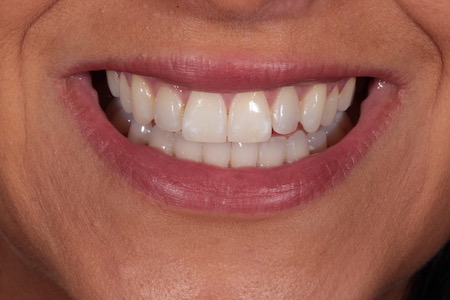 Before Invisalign Treatment Reading Smiles Before Invisalign Treatment Reading Smiles