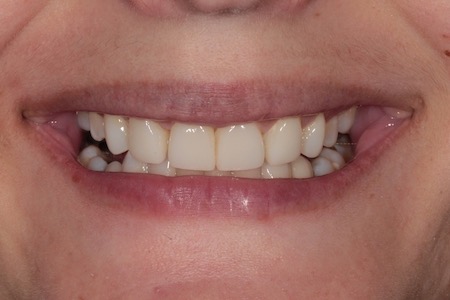 After Veneers Treatment Reading Smiles After Veneers Treatment Reading Smiles