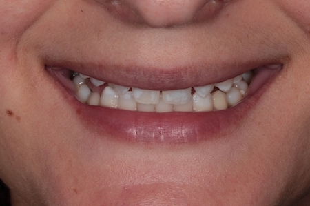 Before veneers Treatment Reading Smiles Before veneers Treatment Reading Smiles
