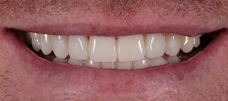 Uneven smile - treatment Composite Bonding-a After Invisalign Treatment Reading Smiles