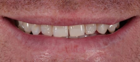Uneven smile - treatment Composite Bonding-b Before & after cosmetic bonding