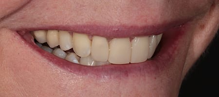 Whitening + composite bonding 2-a-1 After Invisalign Treatment Reading Smiles