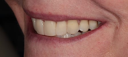 Whitening + composite bonding 2-a-2 After Invisalign Treatment Reading Smiles