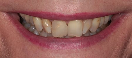 Whitening + composite bonding 2-a Before & after cosmetic bonding