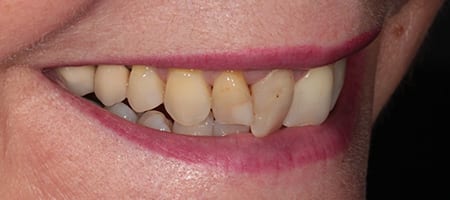 Whitening + composite bonding 2-b-1 Before & after cosmetic bonding