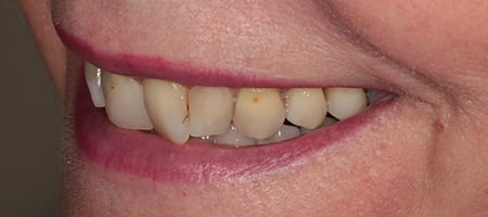 Whitening + composite bonding 2-b-2 Before & after cosmetic bonding
