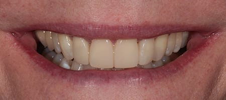 Whitening + composite bonding 2-b After Invisalign Treatment Reading Smiles