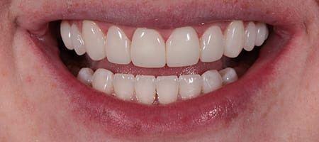 case-1-a-1 After Invisalign Treatment Reading Smiles