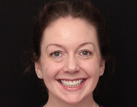 case-1-a After Invisalign Treatment Reading Smiles