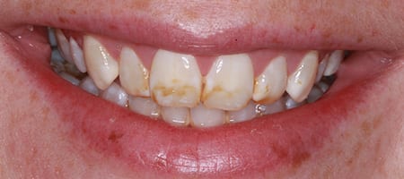 case-1-b-1 Before & after cosmetic bonding