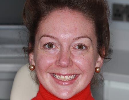 case-1-b Before & after cosmetic bonding