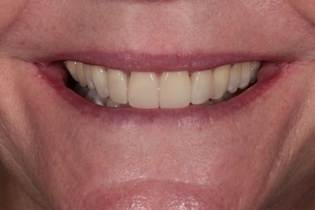 After Smile Makeover Treatment Reading Smiles After Smile Makeover Treatment Reading Smiles
