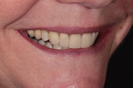 After Smile Makeover Treatment Reading Smiles After Smile Makeover Treatment Reading Smiles