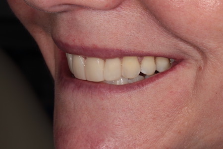 After Smile Makeover Treatment Reading Smiles After Smile Makeover Treatment Reading Smiles