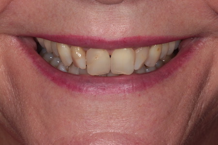 Before Smile Makeover Treatment Reading Smiles Before Smile Makeover Treatment Reading Smiles