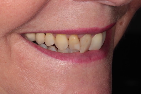 Before Smile Makeover Treatment Reading Smiles Before Smile Makeover Treatment Reading Smiles