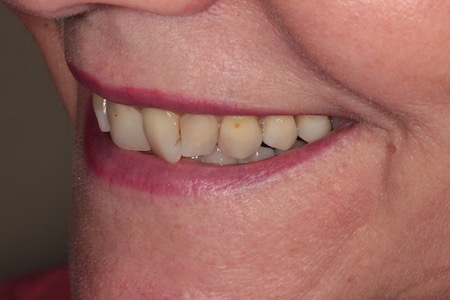 Before Smile Makeover Treatment Reading Smiles Before Smile Makeover Treatment Reading Smiles