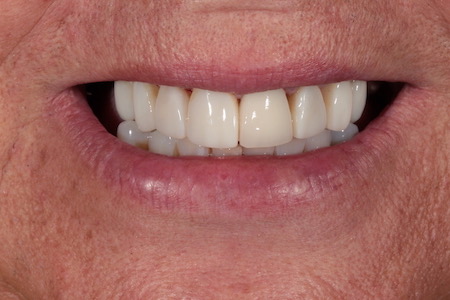 After Veneers Treatment Reading Smiles After Veneers Treatment Reading Smiles