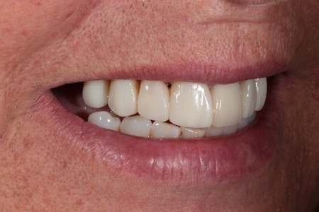 After Smile Makeover Treatment Reading Smiles After Smile Makeover Treatment Reading Smiles