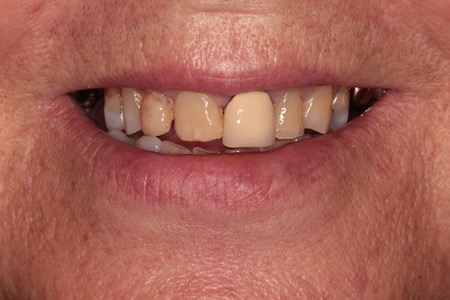 Before veneers Treatment Reading Smiles Before veneers Treatment Reading Smiles