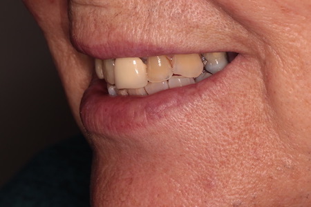 Before Smile Makeover Treatment Reading Smiles Before Smile Makeover Treatment Reading Smiles