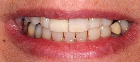 After cosmetic Treatment Reading Smiles After cosmetic Treatment Reading Smiles